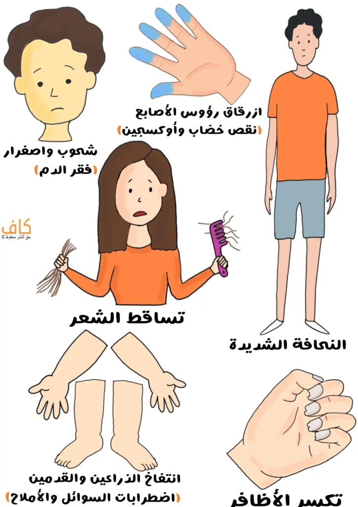 رسم توضيحي يبيّن أعراض القهم العصبي، ويشمل شحوب واصفرار الوجه، ازرقاق رؤوس الأصابع، تساقط الشعر، نحافة شديدة في الجسم، تورم الذراعين والقدمين، وتكسر الأظافر.