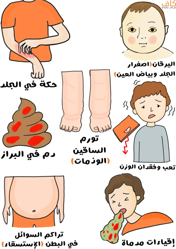 رسم توضيحي يبيّن أعراض نقص ألفا-1 أنتي تريبسين عند الأطفال المصابين بالتهاب الكبد، وتشمل حكة في الجلد، يرقان مع اصفرار الجلد وبياض العينين، تورّم الساقين، وجود دم في البراز، تعب مع فقدان الوزن، تراكم السوائل في البطن (الاستسقاء)، وإقياءات متكررة.