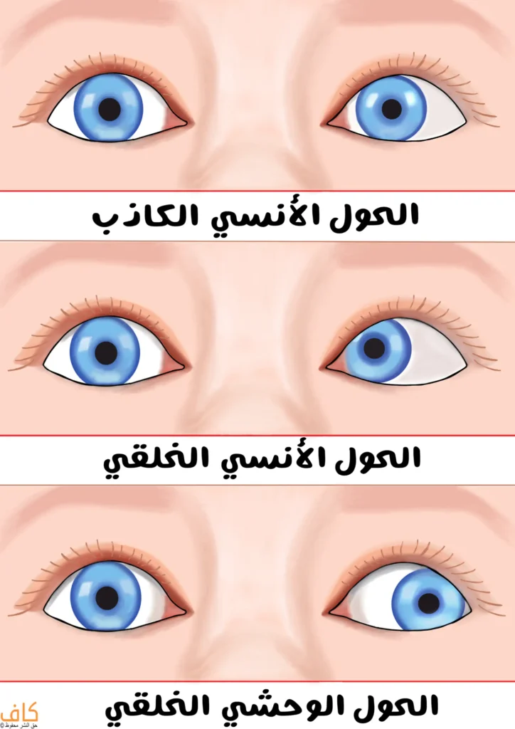 رسم توضيحي يُظهر ثلاثة أزواج من العيون البشرية بأوضاع مختلفة لمحور النظر، يُبيّن في الأعلى العيون في حالة الحول الأنسي الكاذب وفيها تنحرف العين نحو الداخل، وفي المنتصف الحول الأنسي الخلقي ووفي هذه الحالة تنحرف العين بشكل أكبر نحو الداخل، أما في الأسفل فيوجد الحول الوحشي الخلقي وتتجه العين في هذه الحالة تماما نحو الخارج.