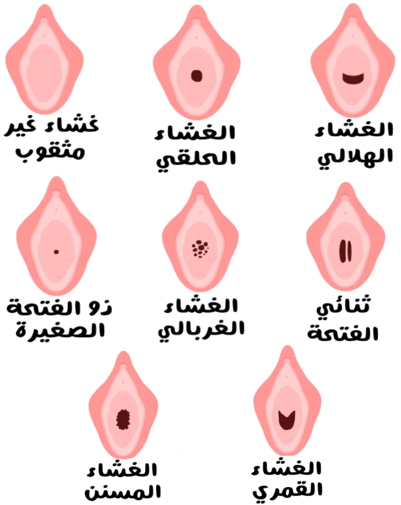 رسم توضيحي يُظهر ثمانية أشكال مختلفة لغشاء البكارة مرتبة في شبكة، تشمل غشاءً غير مثقوب، وغشاءً حلقيًا بفتحة دائرية، وغشاءً هلاليًا بفتحة منحنية، وغشاءً ذا فتحة صغيرة، وغشاءً غرباليًا يحتوي على عدة فتحات صغيرة، وغشاءً ثنائي الفتحة بفتحتين طوليتين، وغشاءً مسنن الحواف، وغشاءً قمري الشكل بفتحة عريضة، ويُعبّر عن أنواع غشاء البكارة.