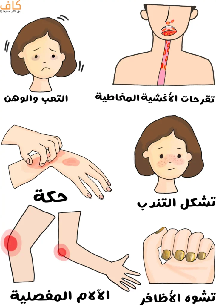 رسم توضيحي يُظهر مجموعة من الأعراض المصوّرة بشكل منفصل، تشمل وجهًا شاحبًا بملامح تعب ووهن، وتجويف الفم والمريء مع تقرحات حمراء على الأغشية المخاطية، ويدًا يُحكّ جلدها مع بقع حمراء، ووجه طفل مع طفح جلدي متناثر، ومفاصل الذراع والساق مع مناطق حمراء دالة على الألم، ويدًا بأظافر مشوهة ومتغيرة اللون.