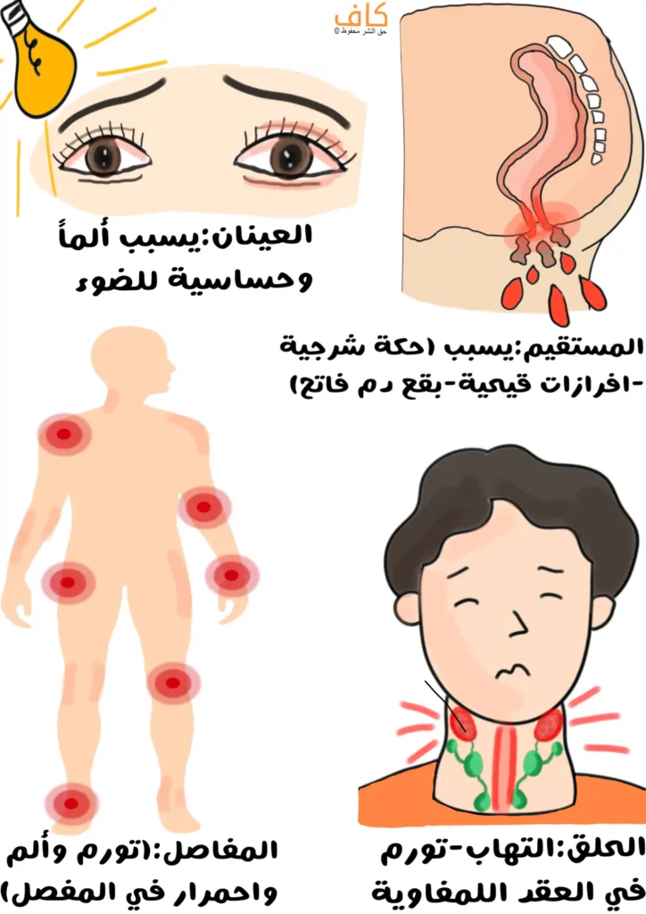 صورة توضيحية تُظهر رسومات للأعضاء التي قد يصيبها السيلان البني، منها عينان حمراء تدلان على الألم وحساسية الضوء، ومقطع تشريحي للمستقيم يبيّن إفرازات ودماء، وشخص يعاني من التهاب وتورم في الحلق والعقد اللمفاوية، وجسم يُظهر دوائر حمراء على المفاصل للدلالة على التورم والألم.
