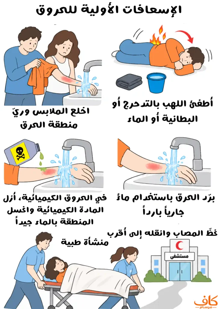 رسمة توضيحية للإسعافات الأولية للحروق، تشمل إزالة الملابس عن منطقة الحرق، إطفاء اللهب، تبريد الحرق بالماء الجاري، غسل الحروق الكيميائية بالماء، وتغطية المصاب ونقله إلى منشأة طبية.