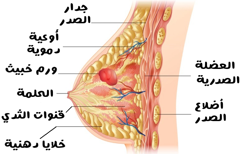 رسم تشريحي جانبي للثدي يُظهر طبقاته الداخلية مع تسميات توضيحية، تشمل جدار الصدر، العضلة الصدرية، أضلاع الصدر، القنوات اللبنية، الحلمة، خلايا دهنية، أوعية دموية، وكتلة حمراء داخل نسيج الثدي تمثل سرطان الثدي.
