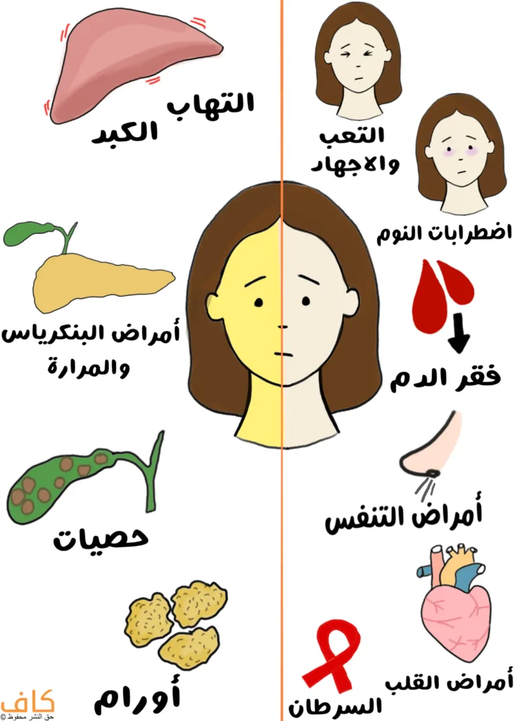 رسم توضيحي يُظهر وجه امرأة مقسوم الى نصفين النصف الأول لونه جلدي طبيعي والنصف الثاني لونه أصفر، وتحيط بها رموز لأعضاء وأمراض مختلفة مثل الكبد، البنكرياس، المرارة، القلب، والرئتين، إلى جانب أشكال تعبّر عن التعب، اضطرابات النوم، فقر الدم، والأورام، ويُعبّر عن الدلالات المرضية التي يمكن أن يشير إليها تغيّر لون البشرة.
