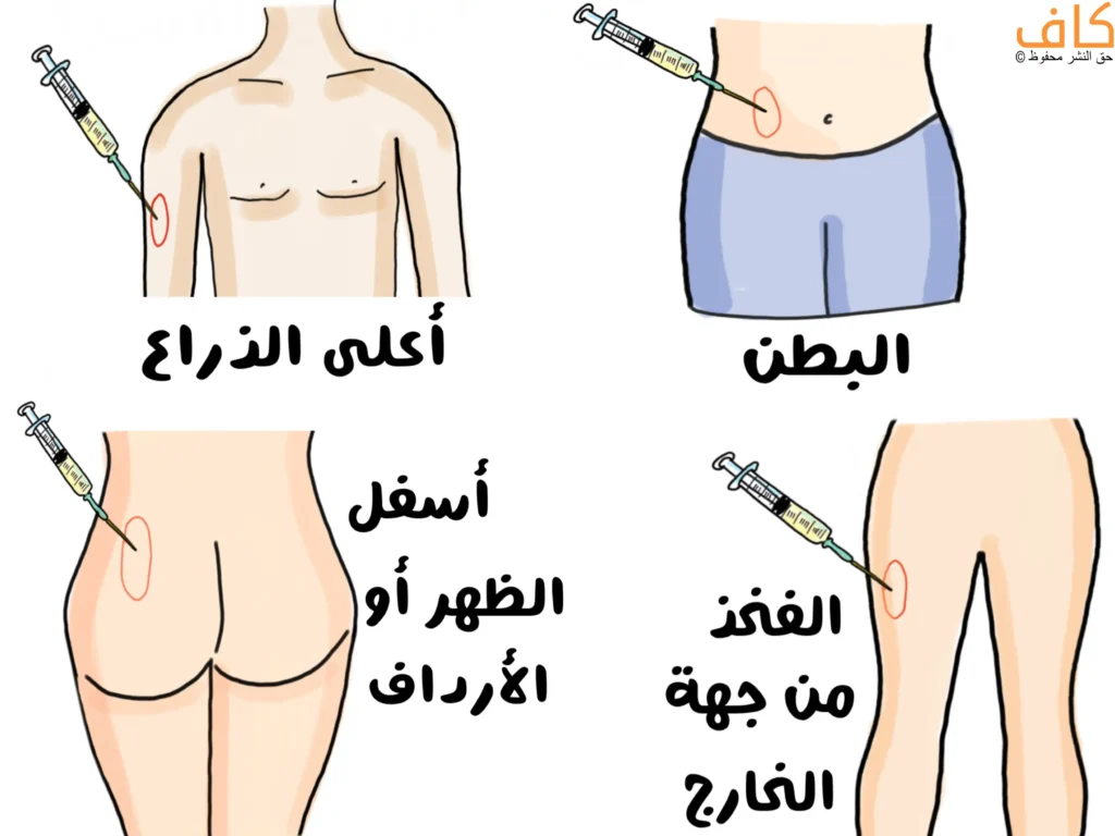 جسم إنسان مرسوم يُظهر مواقع حقن الأنسولين مع إبرة في أعلى الذراع، إبرة في البطن، إبرة في أسفل الظهر أو الأرداف، وإبرة في الفخذ من الجهة الخارجية،