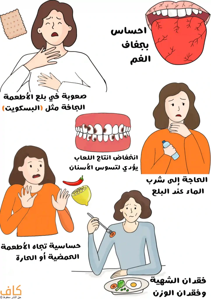 رسم توضيحي يُظهر مجموعة من الأعراض المرتبطة بجفاف الفم، حيث تظهر صورة لسان متشقق، وامرأة تمسك حلقها لتعبّر عن صعوبة في بلع الأطعمة الجافة مثل البسكويت، وصورة فم بأسنان متسوسة ، وامرأة تمسك زجاجة ماء للدلالة على الحاجة المستمرة لشرب الماء، وامرأة تتجنب أطعمة حارة وحامضة ، وفي الأسفل امرأة تبدو فاقدة للشهية أمام طبق طعام.