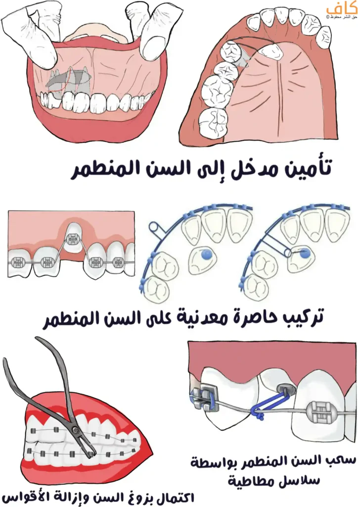 رسم توضيحي يشرح خطوات الجرّ التقويمي للأسنان، يبدأ بتأمين مدخل إلى السنّ المنطمر داخل اللثة، ثم تركيب حاصرة معدنية على السنّ المنطمر، وبعدها سحب السنّ تدريجيًا باستخدام سلاسل مطاطية مرتبطة بجهاز التقويم، وينتهي باكتمال بزوغ السنّ وإزالة الأقواس بعد انتظام الأسنان.