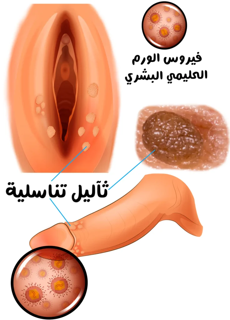 رسم توضيحي يُظهر الأعضاء التناسلية الأنثوية والذكرية مع نتوءات صغيرة فاتحة اللون على الجلد، وتكبير دائري لجزيئات فيروسية، وصورة قريبة لثؤلول جلدي غير منتظم السطح يظهر على شكل دائري سطحه متعرج.
