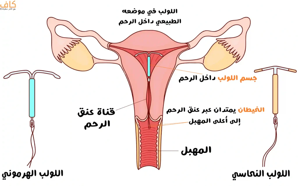 رسم توضيحي يبين شكل اللولب داخل الرحم، مع توضيح موضع اللولب الهرموني واللولب النحاسي داخل تجويف الرحم وامتداد الخيطين عبر عنق الرحم إلى المهبل.