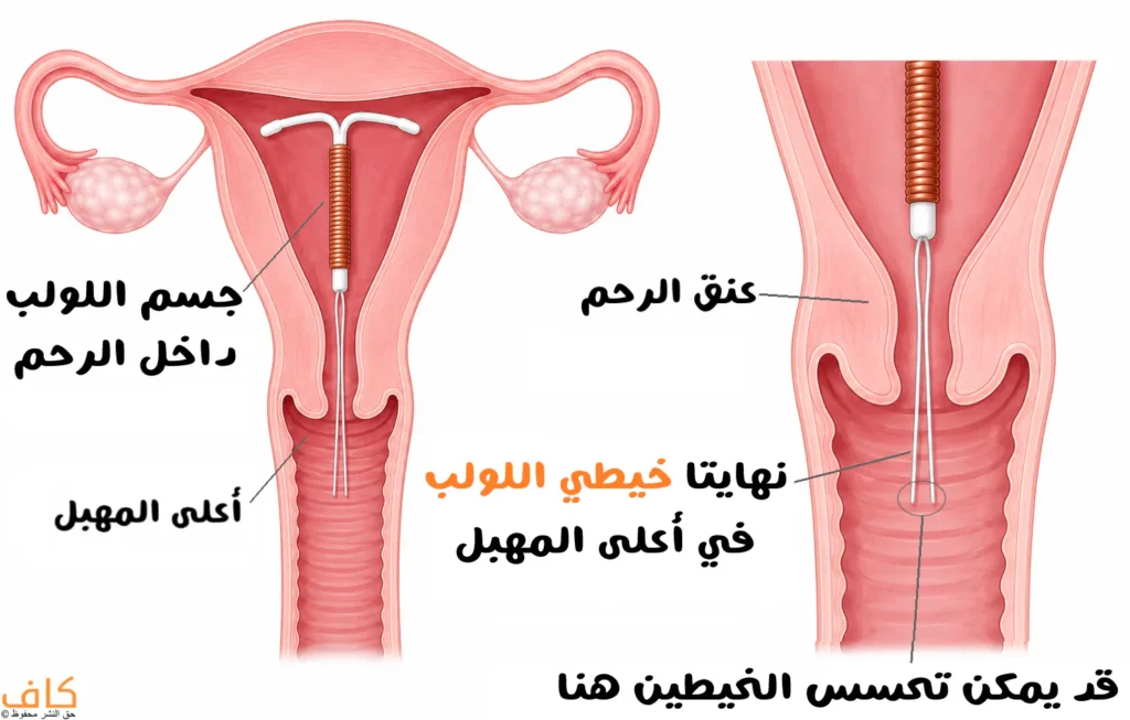 رسم توضيحي يبين شكل خيطي اللولب ومكان مرورهما عبر عنق الرحم وانتهاء نهايتيهما في أعلى المهبل، مع توضيح الجزء الذي قد يمكن تحسسه.