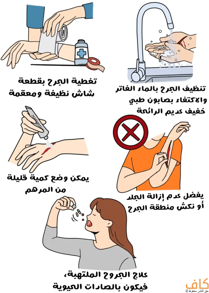 رسم توضيحي يتكوّن من عدة مشاهد لعلاج الجروح؛ يدان تقومان بلف شاش نظيف ومعقم حول جرح مع وجود عبوة مطهّر وشريط لاصق، ويدان تُغسلان جرحًا تحت ماء جارٍ من صنبور مع رغوة صابون، ويد تضع كمية صغيرة من مرهم على جرح مفتوح، وشخص يحاول نزع الجلد أو حكّ جرح في الذراع مع علامة منع حمراء فوق المشهد، وامرأة تبتلع حبوب دواء.